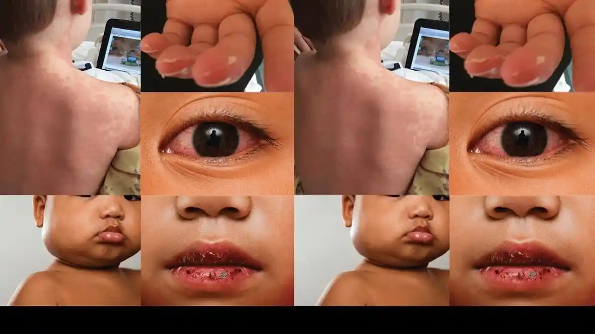 Waspada Penyakit Kawasaki pada Anak: Bisa Picu Risiko Serangan Jantung Serius!